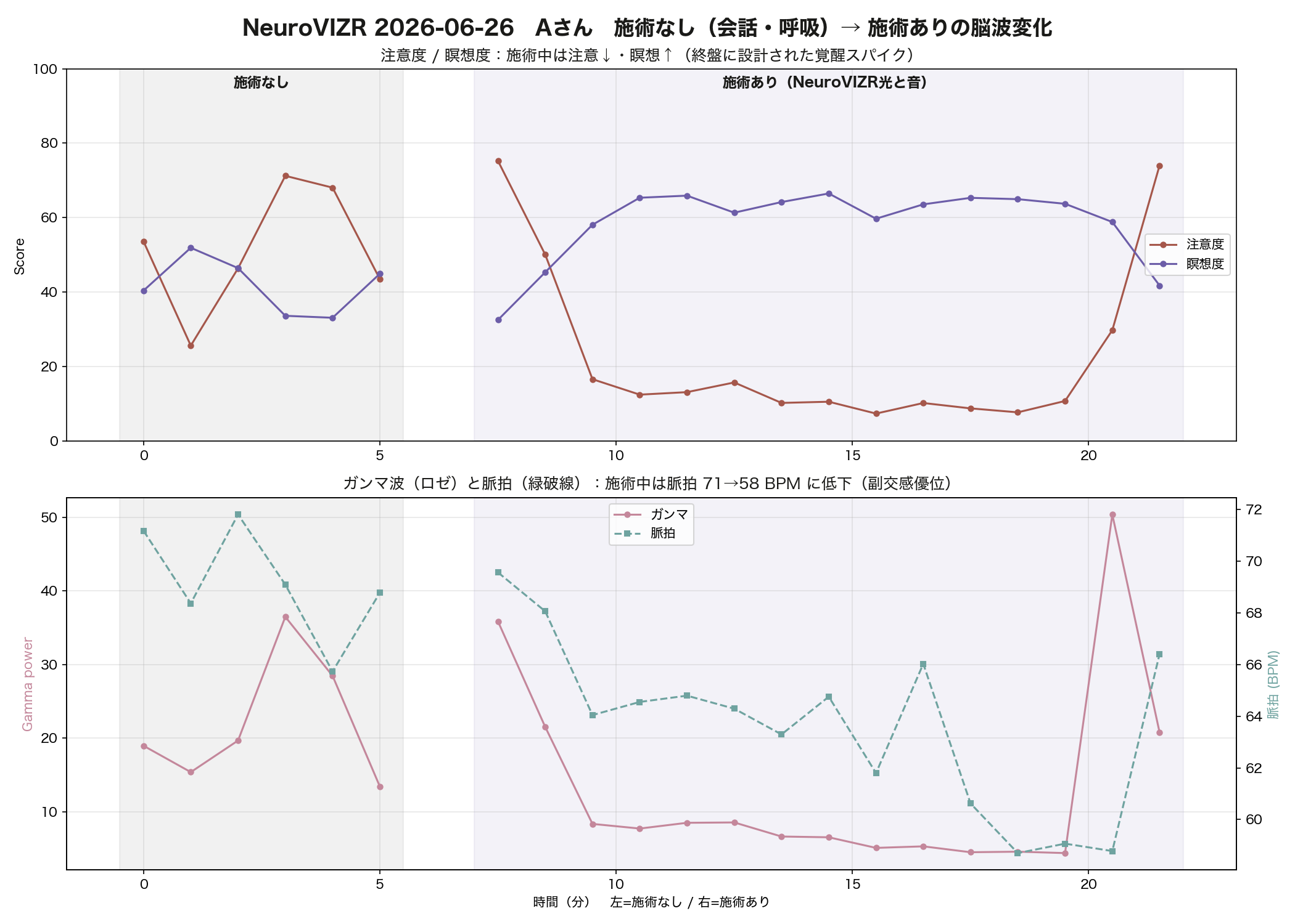 Aさんの施術なし・施術ありの脳波変化。施術中は注意度が下がり瞑想度が上がる